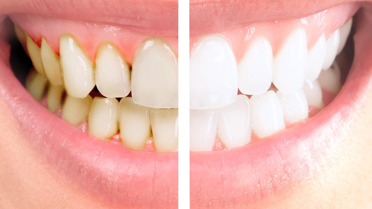 Сколько Длится Белая Диета После Чистки Зубов