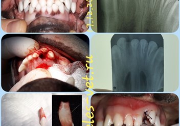 Если есть лишние зубы, которые мешают нормальному смыканию челюстей, то их нужно удалять. Много зубов так же плохо, как и мало.