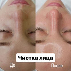 Чистка лица