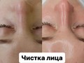 Чистка лица