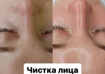 Чистка лица