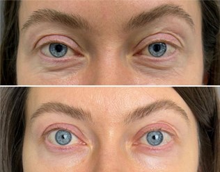 Микроигольчатый RF-лифтинг