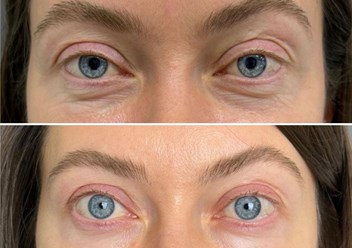 Микроигольчатый RF-лифтинг