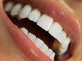 гигиеническая чистка зубов системой аэр флоу и полностью безопастное отбеливание без нагрева и ультрафиолета. http://denterum.ru/otbelivanie-zubov Самара стоматология