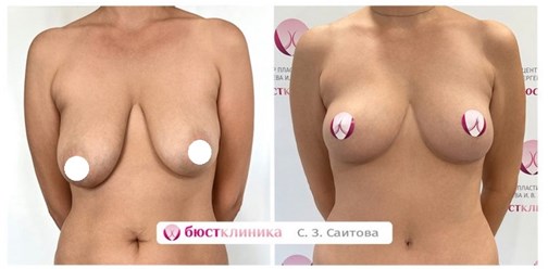 Фото До и После подтяжки груди без имплантов
