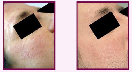 Пилинг PRX-T33- терапия. Курс4 процедуры, 1 процедура в 7-10 дней. Выравнивание текстуры и цвета кожи, сужение пор, исчезают мелкие морщины, увлажнение кожи.