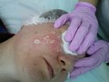 Удаление новообразований на лице в Кемерово