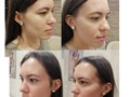 Сеанс Буккального массажа фото до/после