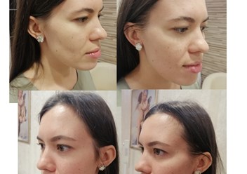 Сеанс Буккального массажа фото до/после