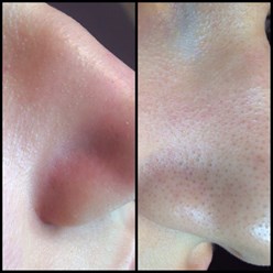 Чистка лица Кристина Комодекс