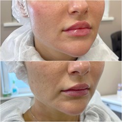 Контурная пластика губ, носогубной, периоральной областей.