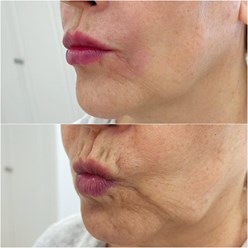 Контурная пластика губ, носогубной складки. Постановка нейротоксина.