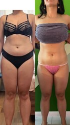 Резульатат 20 сеансов аппаратного RSL-массажа