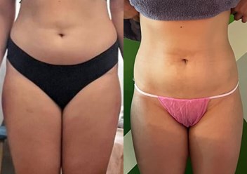 Резульатат 20 сеансов аппаратного RSL-массажа