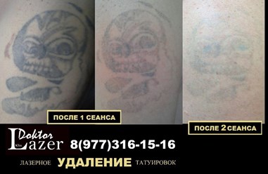 Фото компании  Лазерное удаление татуировок и татуажа 4