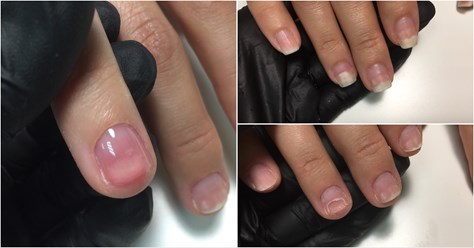 Протезирование ногтей при отсутствии патологической флоры. Онихолизис.