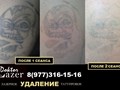 Фото компании  Лазерное удаление татуировок и татуажа 4