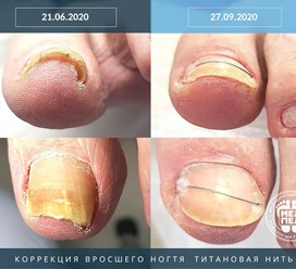 Коррекция вросшего ногтя. Титановая нить