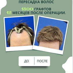 Примеры наших работ в трихологической клинике. Пересадка волос за 1 день. Бесшовный метод.