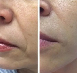 Коррекция носогубных складок