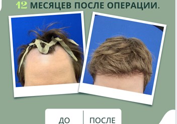 Примеры наших работ в трихологической клинике. Пересадка волос за 1 день. Бесшовный метод.