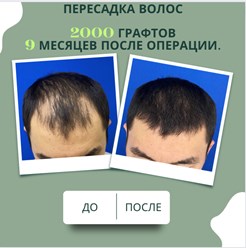 Примеры наших работ в трихологической клинике. Пересадка волос за 1 день. Бесшовный метод.