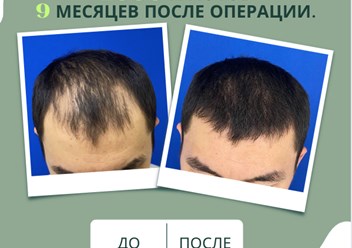 Примеры наших работ в трихологической клинике. Пересадка волос за 1 день. Бесшовный метод.