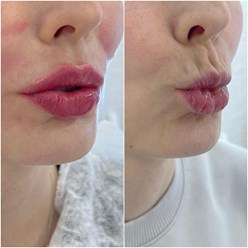 Контурная пластика периоральной области и губ. Постановка нейротоксина.