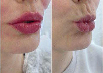 Контурная пластика периоральной области и губ. Постановка нейротоксина.