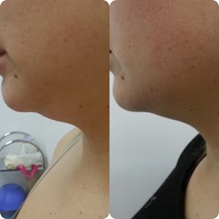 Процедуры с препаратами Чеккарелли.
Результат на 4-ый день.
Fat Apoptosus Body