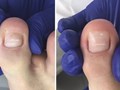 Восстановление ногтевой пластины, протезирование