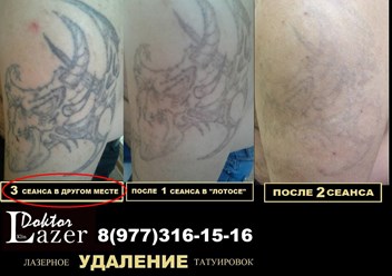 Фото компании  Лазерное удаление татуировок и татуажа 2