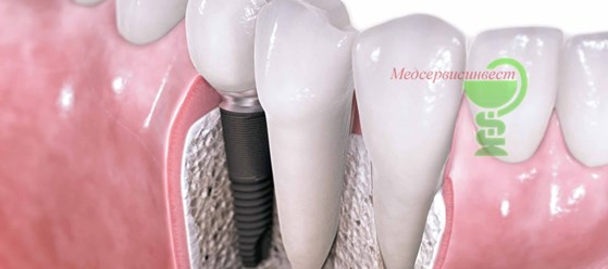 металлокерамические протезы на зубы