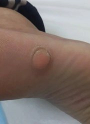 Удаление шипицы в Кемерово