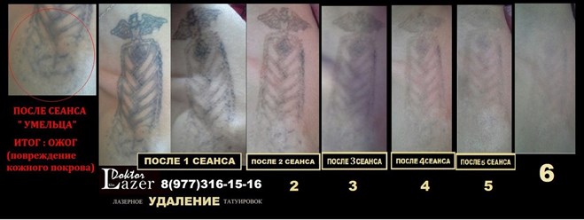 Фото компании  Лазерное удаление татуировок и татуажа 1