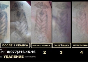 Фото компании  Лазерное удаление татуировок и татуажа 1