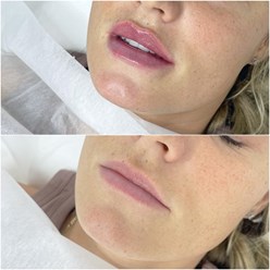 Контурная пластика губ. Европейский препарат.