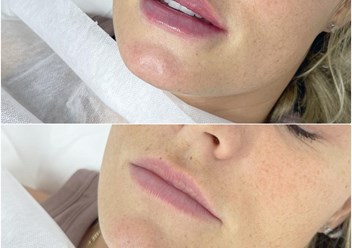 Контурная пластика губ. Европейский препарат.