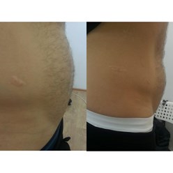 NATINUEL FAT NORMALIZE -препарат для уменьшения объема жировой ткани тела.
📌Апоптоз клеток, применяемый на избытке адипозной ткани на теле, позволяет без вреда уменьшить ее объемы.