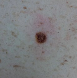 Удаление новообразований на теле в Кемерово