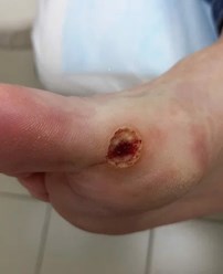 Удаление подошвенной бородавки в Кемерово