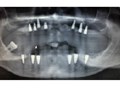 зубная имплантация при полной или частичной потери зубов.  Высокая степень приживаемости имплантантов. http://denterum.ru/prizhivaemost-implantov Импланты в Самаре