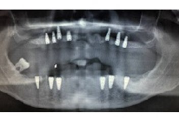 зубная имплантация при полной или частичной потери зубов.  Высокая степень приживаемости имплантантов. http://denterum.ru/prizhivaemost-implantov Импланты в Самаре