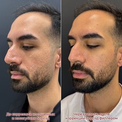 Контурная пластика