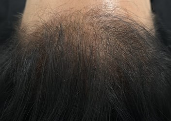 трихопигментация