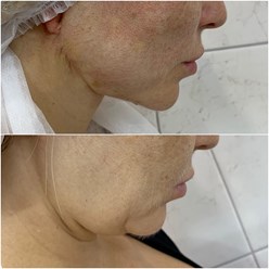 Постановка лифтинговых нитей.