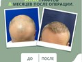 Примеры наших работ в трихологической клинике. Пересадка волос за 1 день. Бесшовный метод.