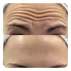 Ботулинотерапия