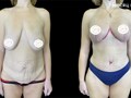 Липоабдоминопластика + маммопластика (пластика груди)