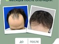 Примеры наших работ в трихологической клинике. Пересадка волос за 1 день. Бесшовный метод.